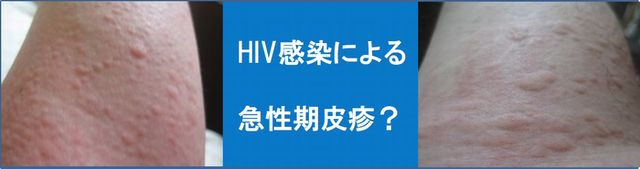 HIV急性期皮疹